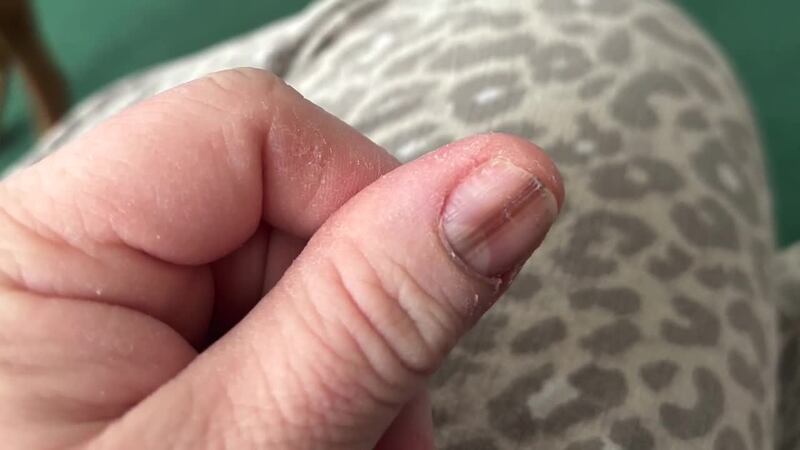 A brown line on a woman's fingernail turned out to be a rare form of melanoma.