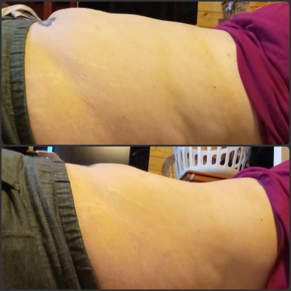 A before (top photo) and after pic (bottom photo) from lymphatic drainage.