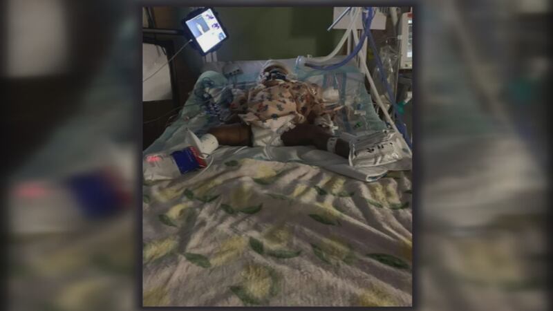 A 1-year-old girl is at USA’s Children’s and Women’s hospital suffering from severe burns...