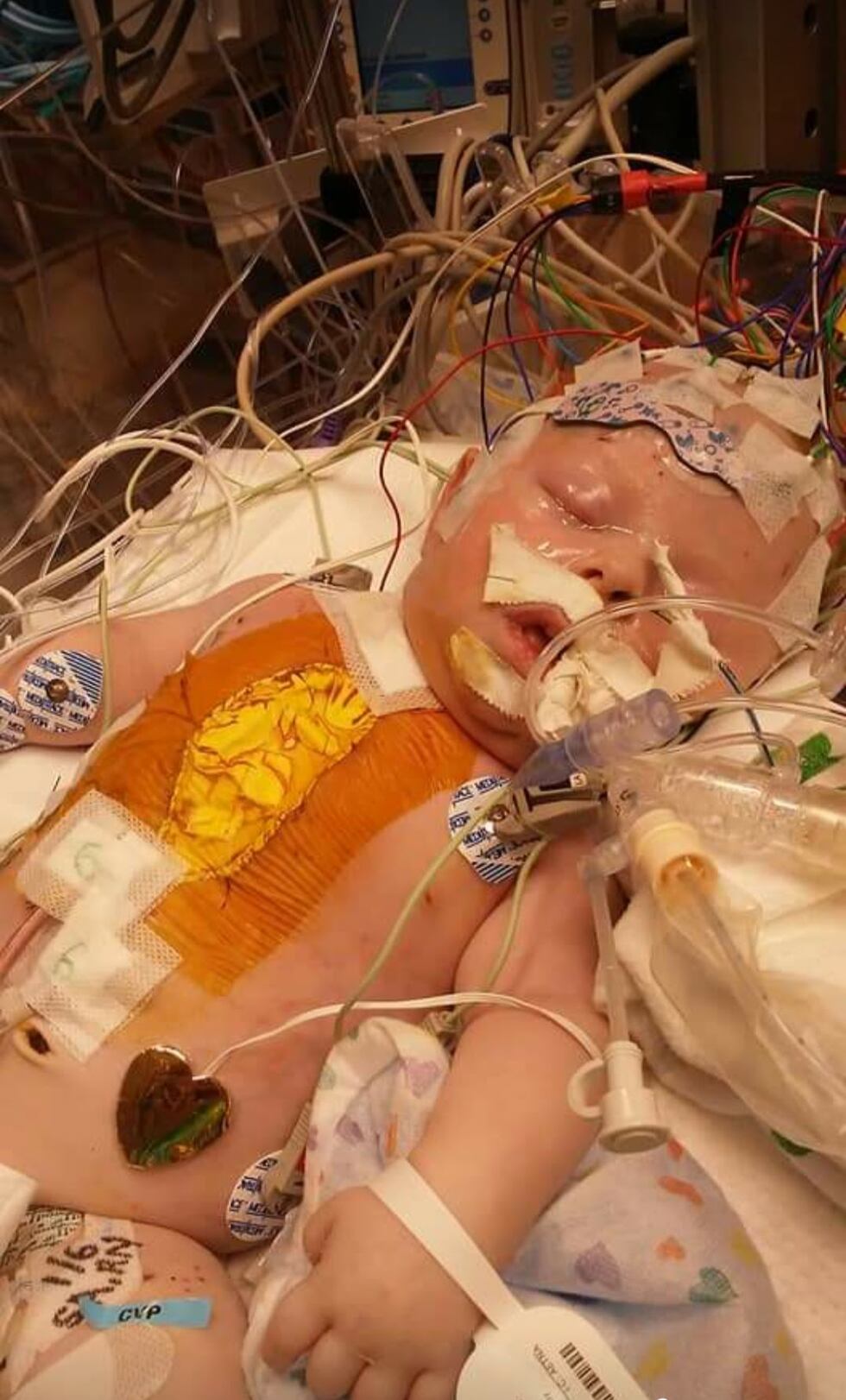 Baby Liam in the hospital after heart surgery.