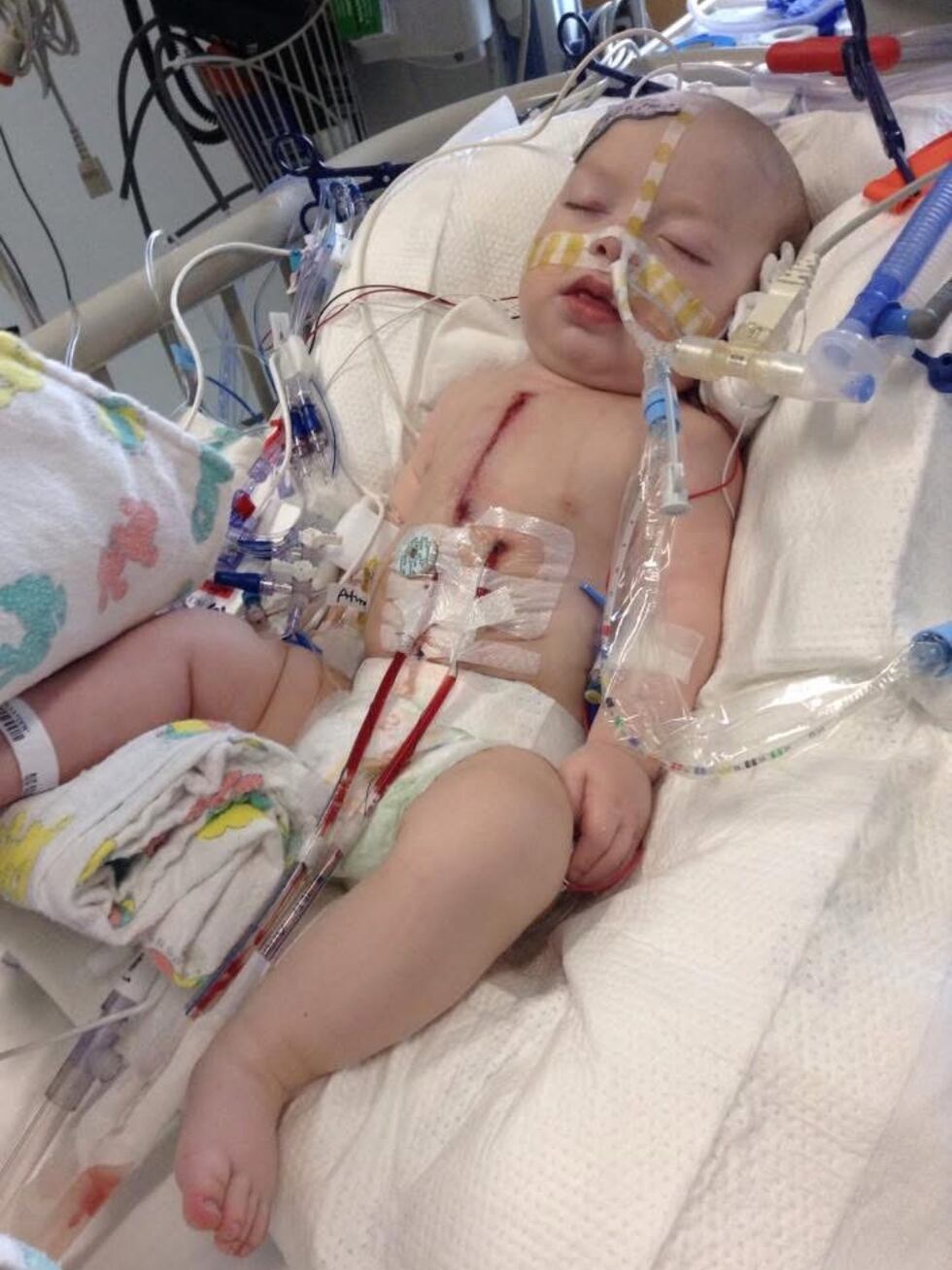 Kayden recovering after open heart surgery.