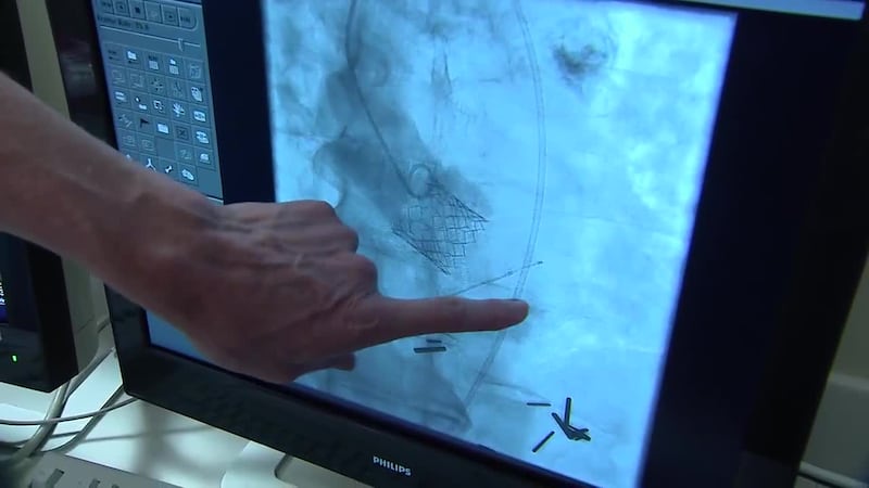 Dr. Stan Watkins explaining the success of a Transcatheter Aortic Valve Replacement (TAVR)...